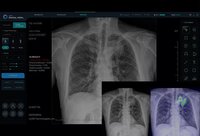 MINE ALNU (Nooka): Φορητό Σύστημα Ακτινογραφίας με AI & FDA