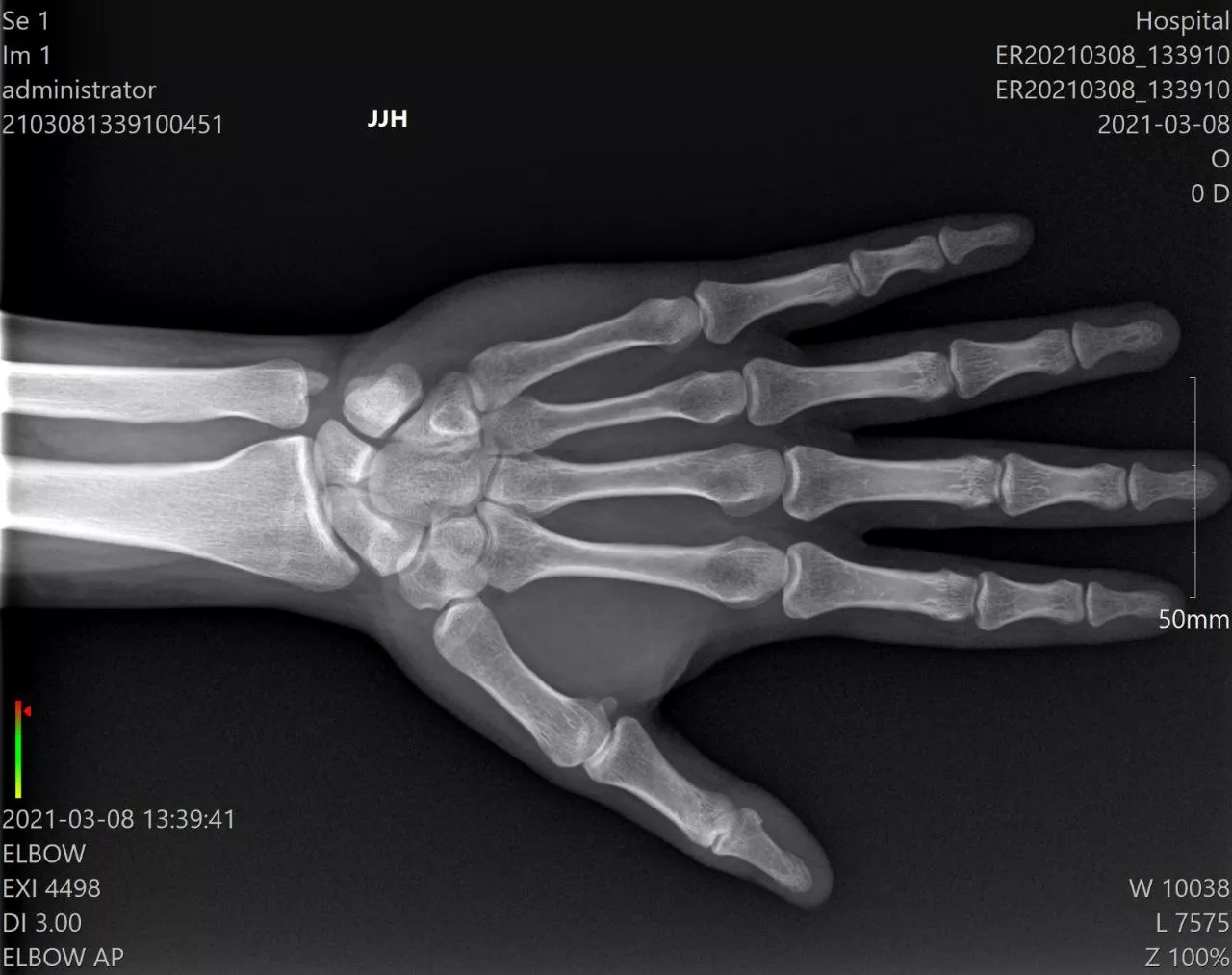 MINE ALNU (Nooka): Φορητό Σύστημα Ακτινογραφίας με AI & FDA