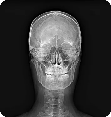 MINE ALNU (Nooka): Φορητό Σύστημα Ακτινογραφίας με AI & FDA