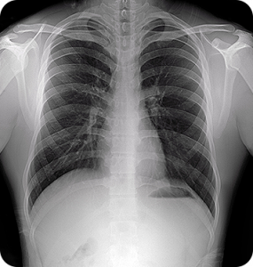 Mine Alnu Nooka X-ray of a chest