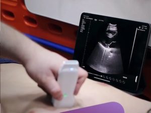 Konted wireless-ultrasound probe used in cardiology