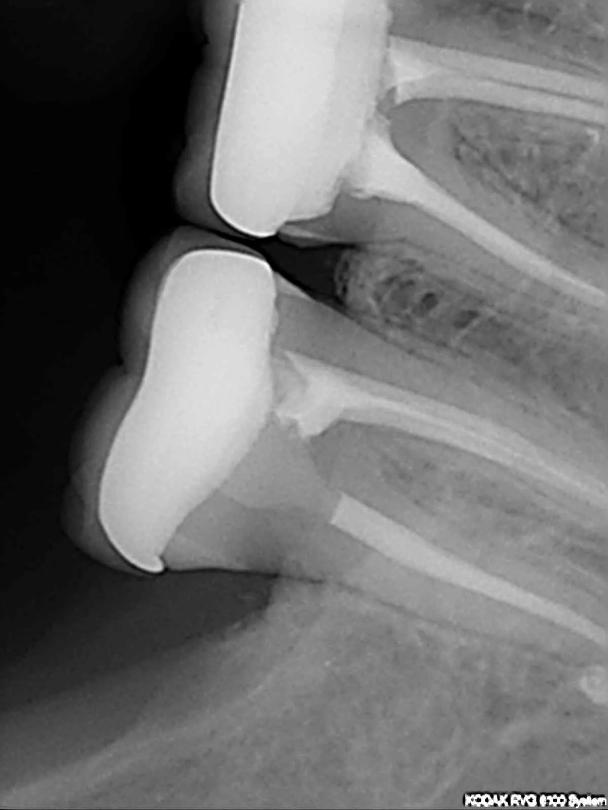 Posdion Rextar-X: Portable Handheld Dental X-Ray 70kV – High-Safety Imaging