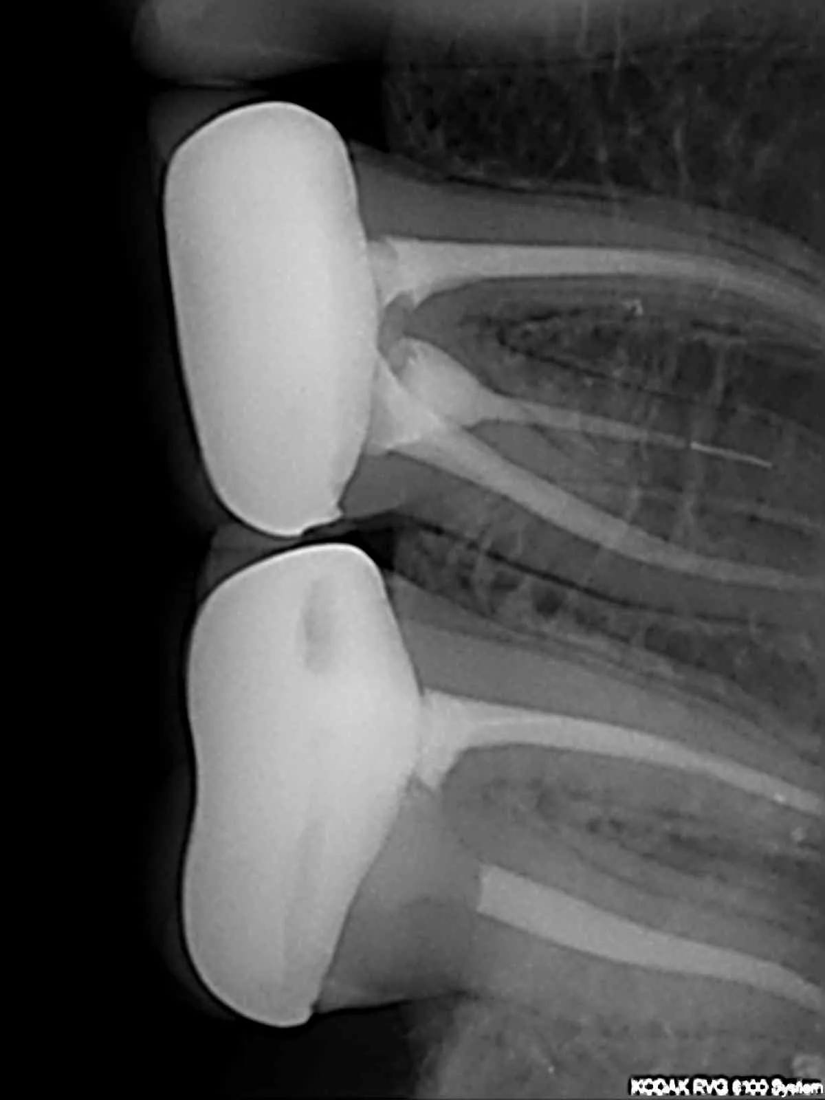 Posdion Rextar-X: Portable Handheld Dental X-Ray 70kV – High-Safety Imaging