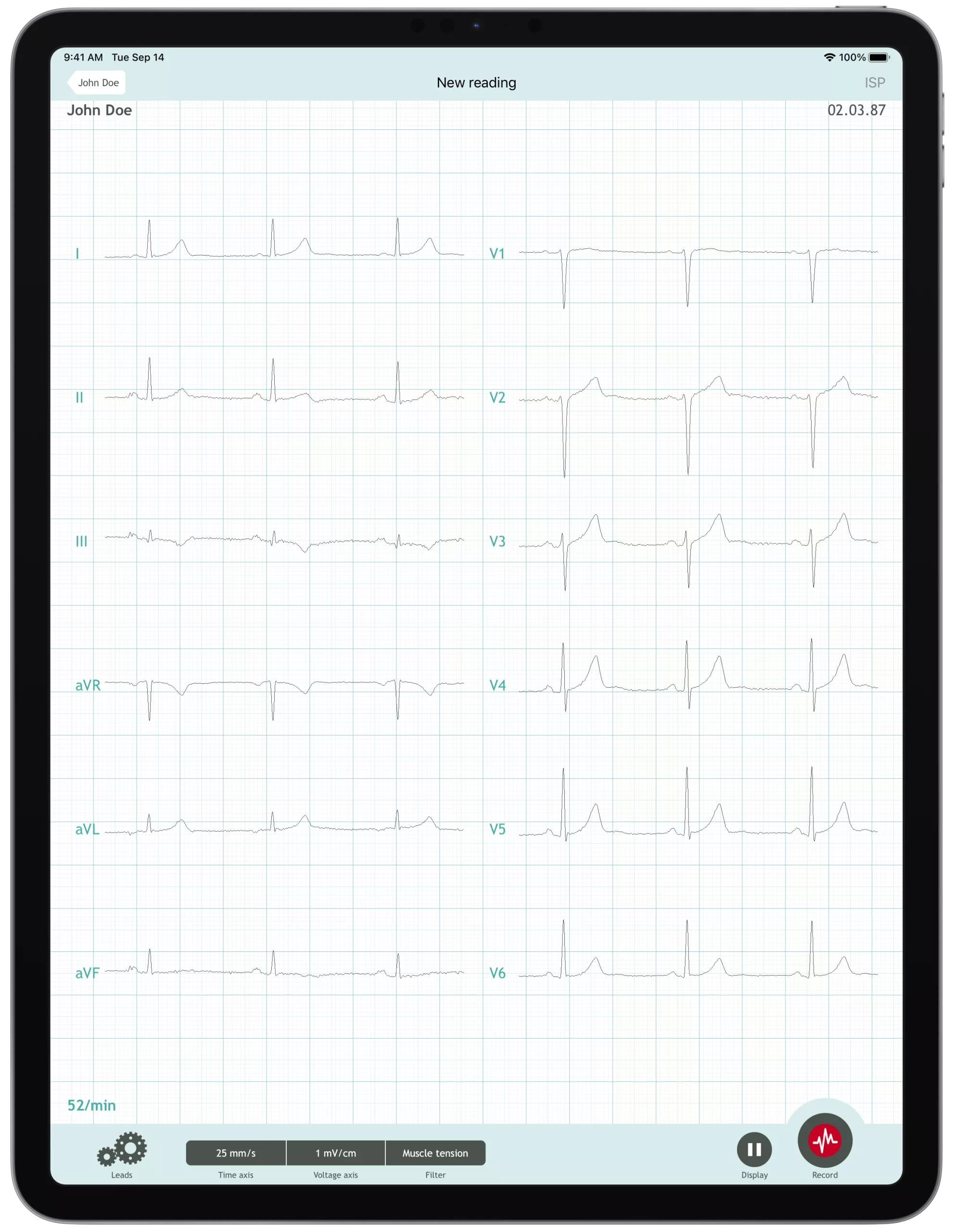 CardioSecur Pro: Professional 22-Lead Wireless ECG for Smartphones